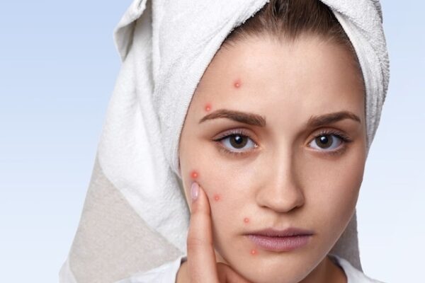 Boils and Skin Infections Increase in Summer: Measures to avoid boils in summer, doctors couple Rajput tips