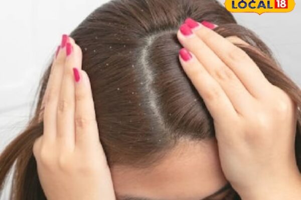 Hair Care Tips: As soon as the rain comes, the problem of dandruff? Follow this surefire solution, will start appearing in a few days
