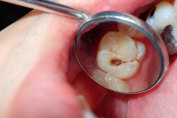 Home Remedies for Tooth Cavity. Relief from teeth insects