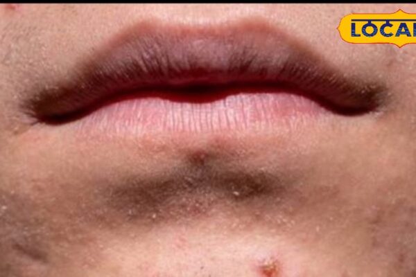 These 7 things will be eliminated from the root of pimples, you will get easily at home