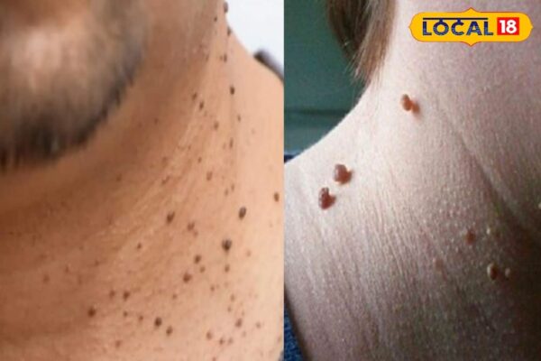 Health Tips: If you are disturbed by warts, then these domestic and cheap tips will work, know easy remedies – uttar pradesh news