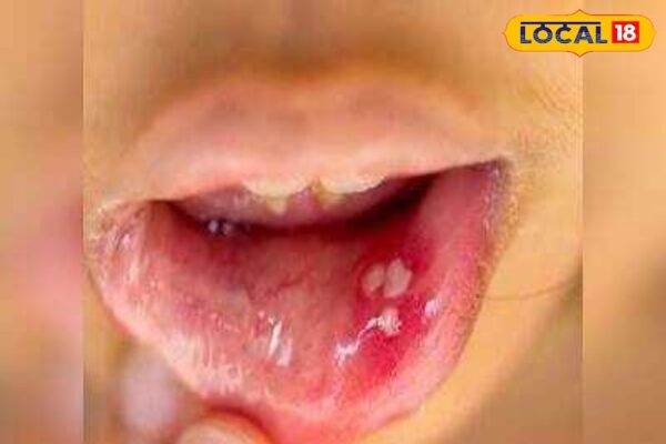 Health Tips: Mouth ulcers are disturbed, try these home remedies, will get immediate rest